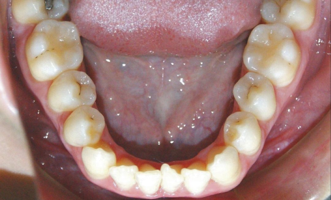 Antes do tratamento Invisalign