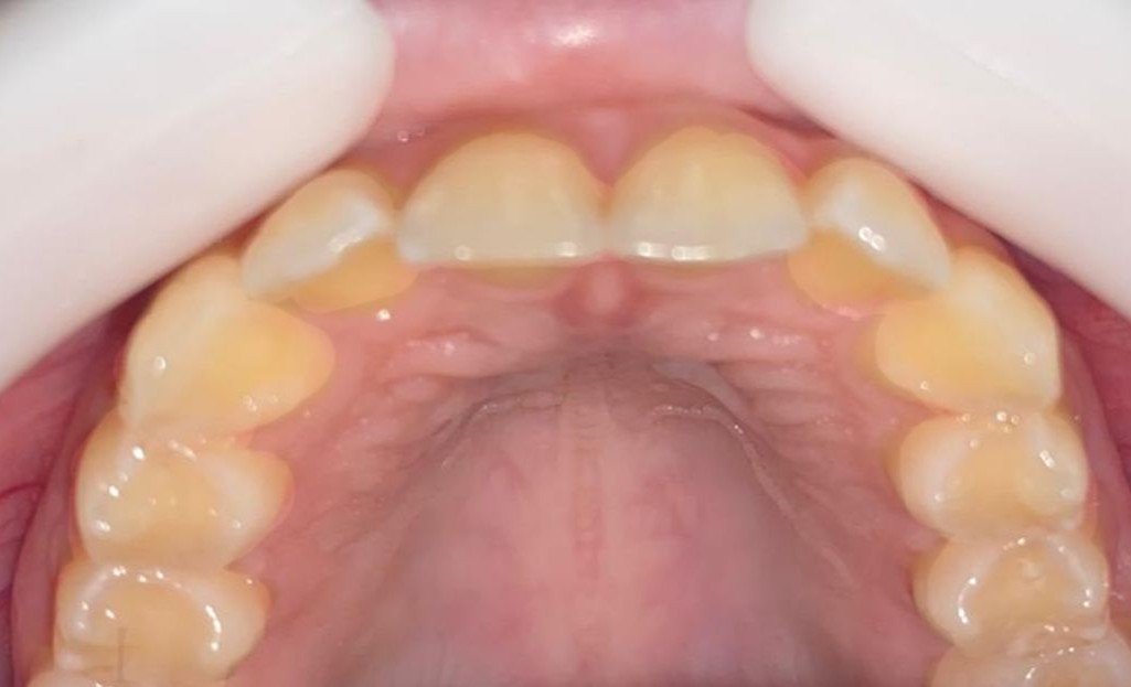 Antes do tratamento Invisalign 2